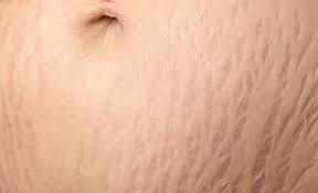 عوامل تاثیرگذار در کشیدگی پوست و شکل گیری ترک پوستی