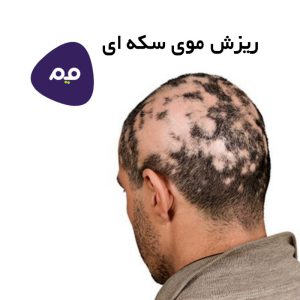 درمان ریزش مو سکه ای و علت و علائم